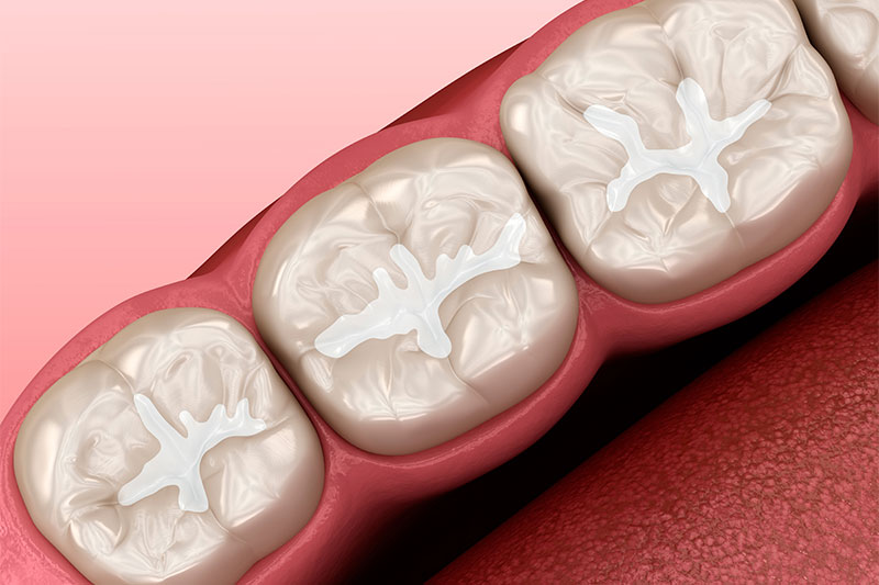 Dental Bonding in Fairfax