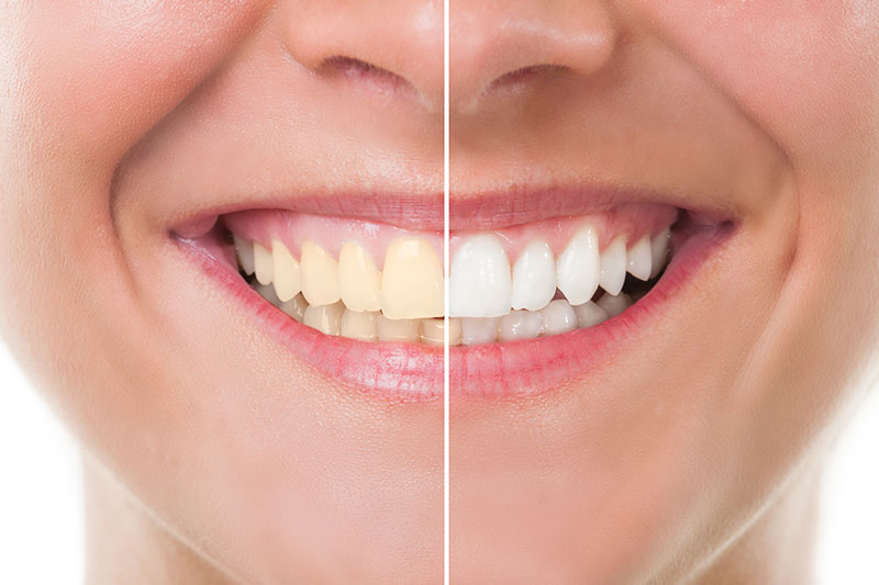 Teeth Whitening in Fairfax